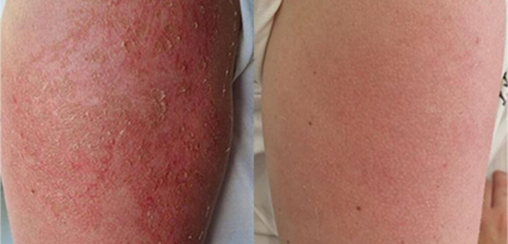 Dermalux LED Phototherapy