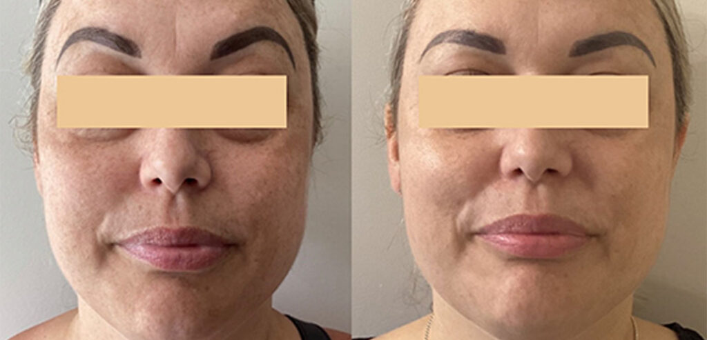 Dermaroller Microneedling