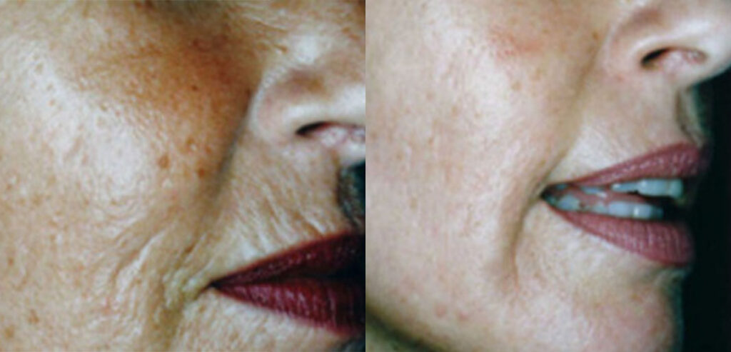 Dermaroller Microneedling
