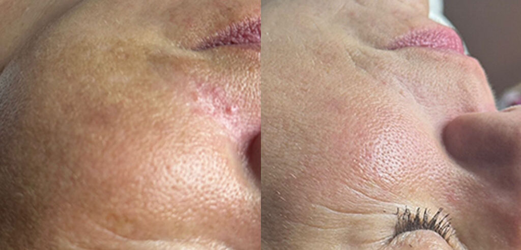 Dermaroller Microneedling