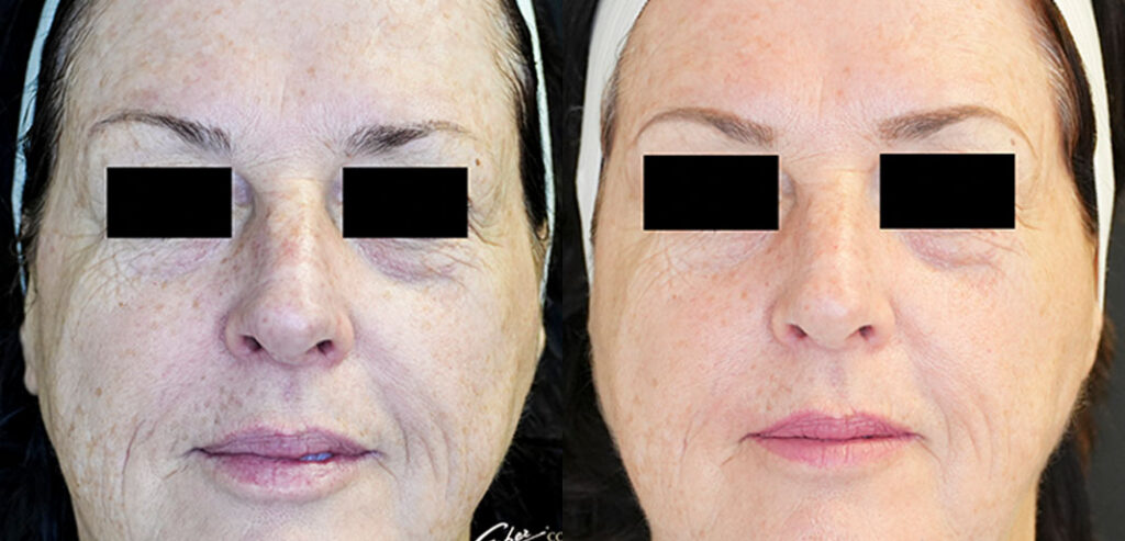 Dermaroller Microneedling
