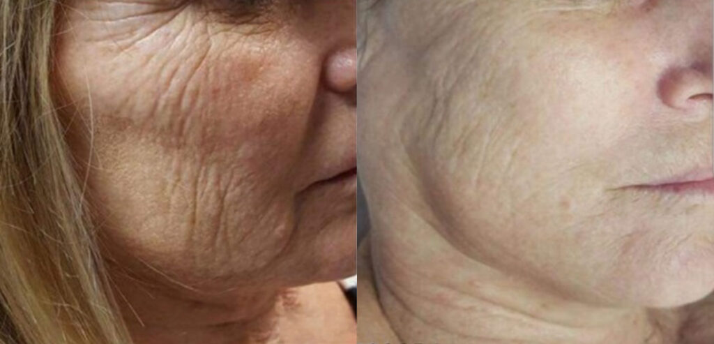 Dermaroller Microneedling