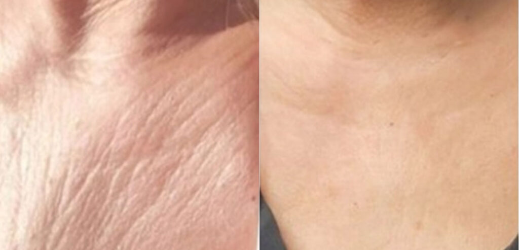 Dermaroller Microneedling