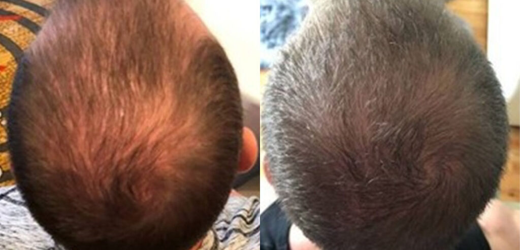 Dermaroller Microneedling