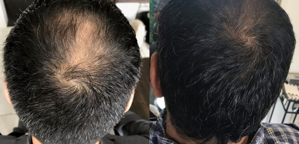 Dermaroller Microneedling