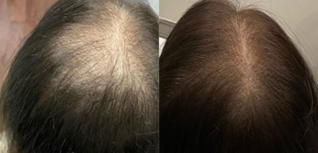Dermaroller Microneedling