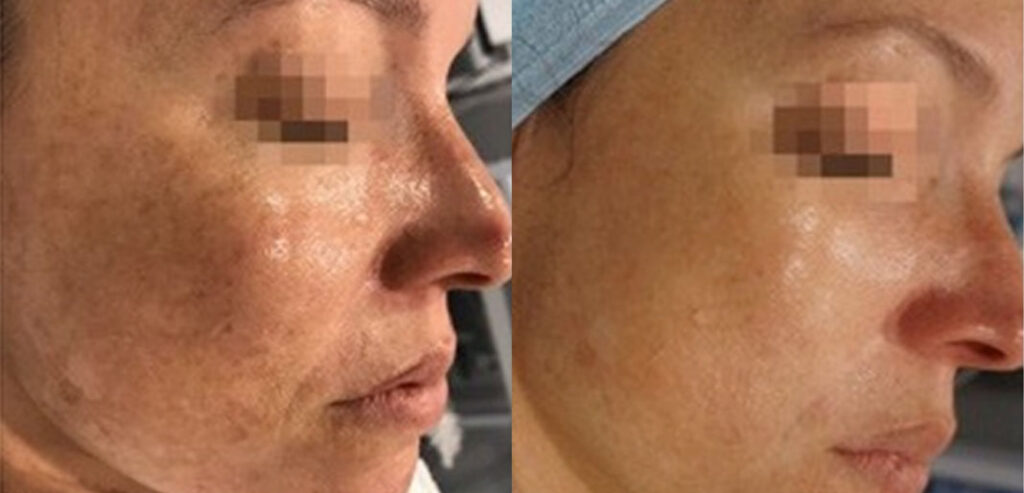 Dermaroller Microneedling