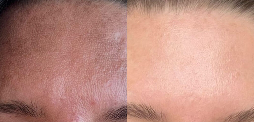 Dermaroller Microneedling