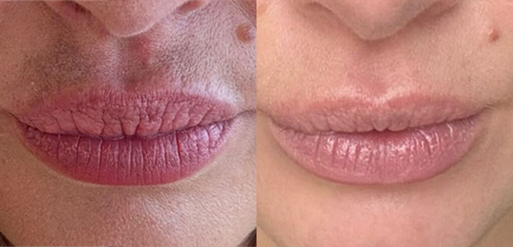Dermaroller Microneedling