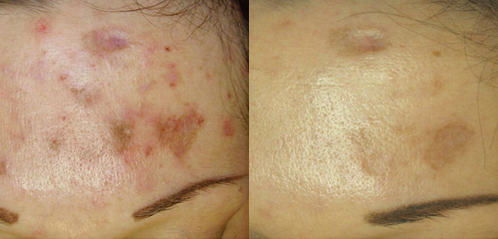 Dermaroller Microneedling