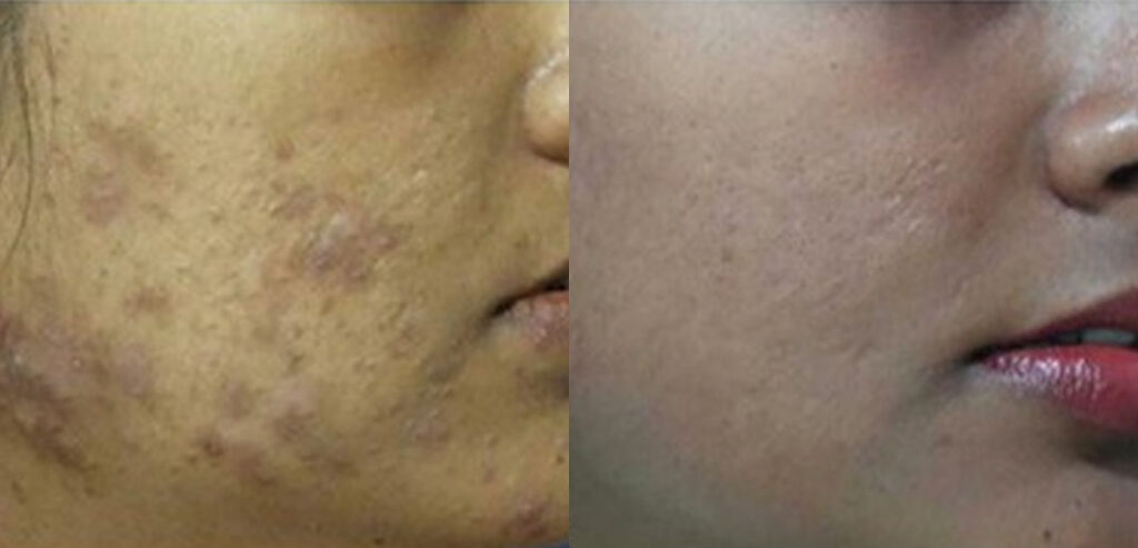 Dermaroller Microneedling
