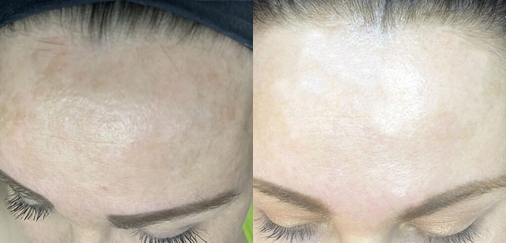 Dermaroller Microneedling