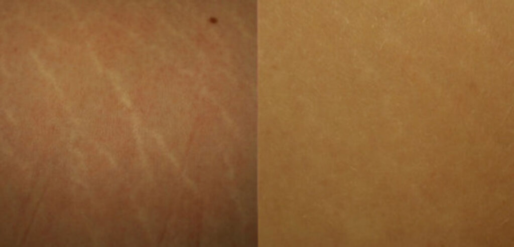 Dermaroller Microneedling
