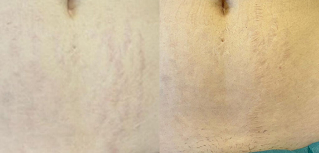 Dermaroller Microneedling