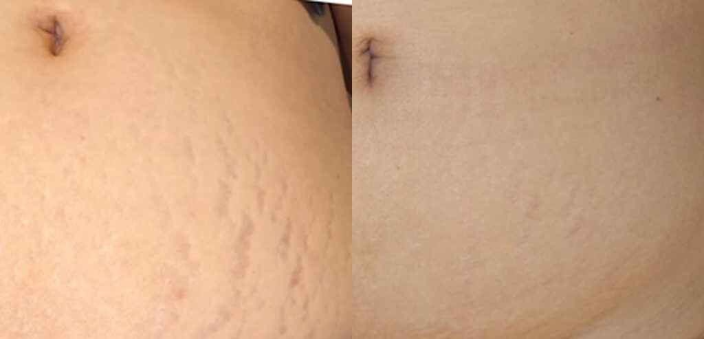 Dermaroller Microneedling