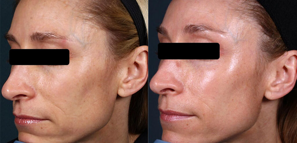 Divine Pro — Non-Surgical Facelift