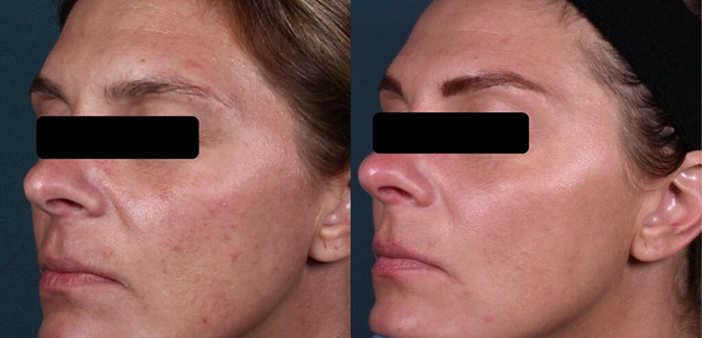 Divine Pro — Non-Surgical Facelift