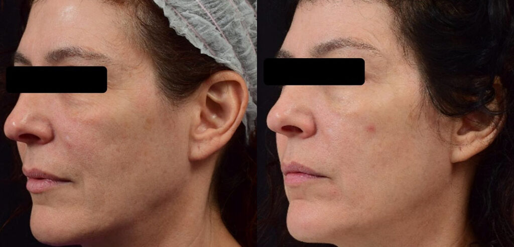 Divine Pro — Non-Surgical Facelift