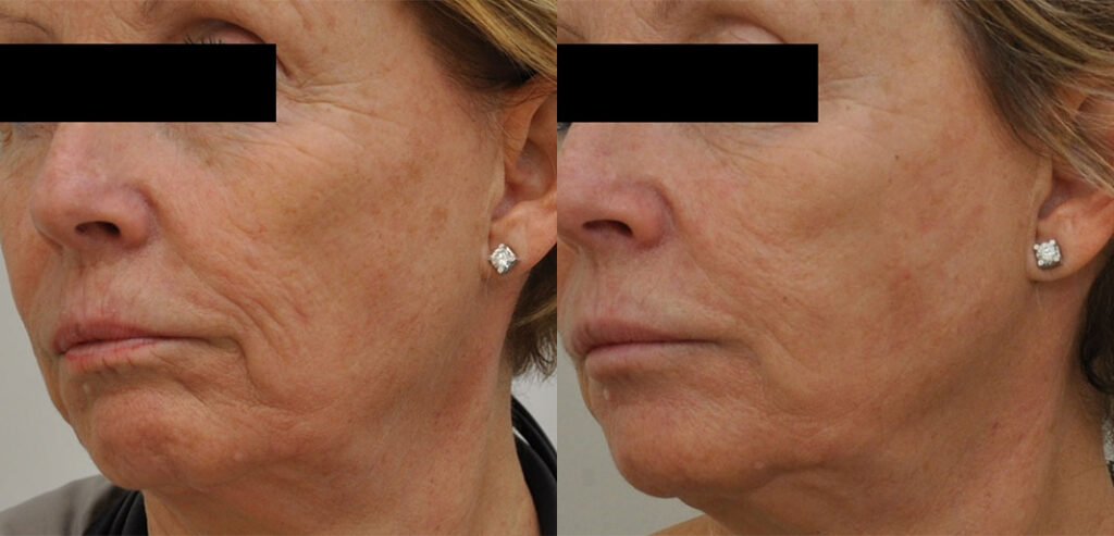 Divine Pro — Non-Surgical Facelift