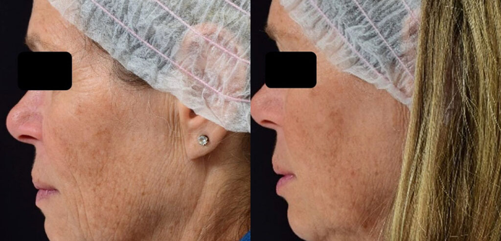 Divine Pro — Non-Surgical Facelift