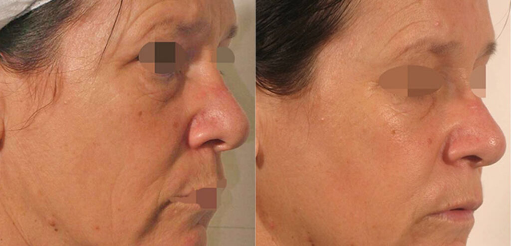 Divine Pro — Non-Surgical Facelift