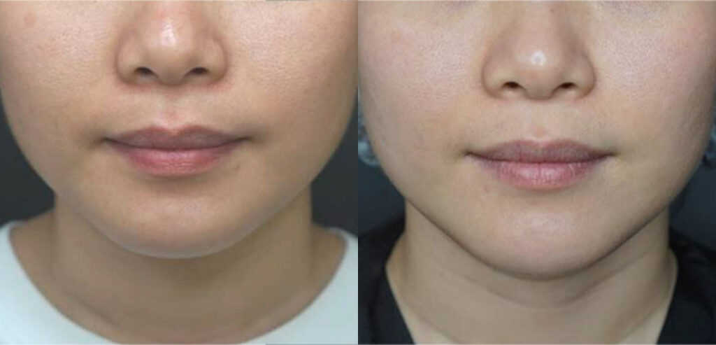 Divine Pro — Non-Surgical Facelift