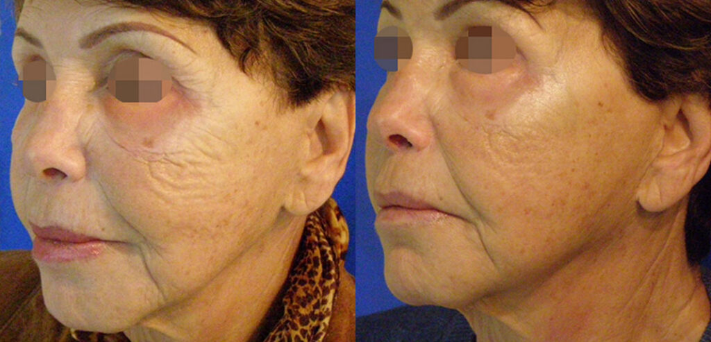 Divine Pro — Non-Surgical Facelift