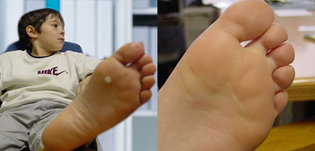 FreezPen — Precision Spot & Lesion Removal
