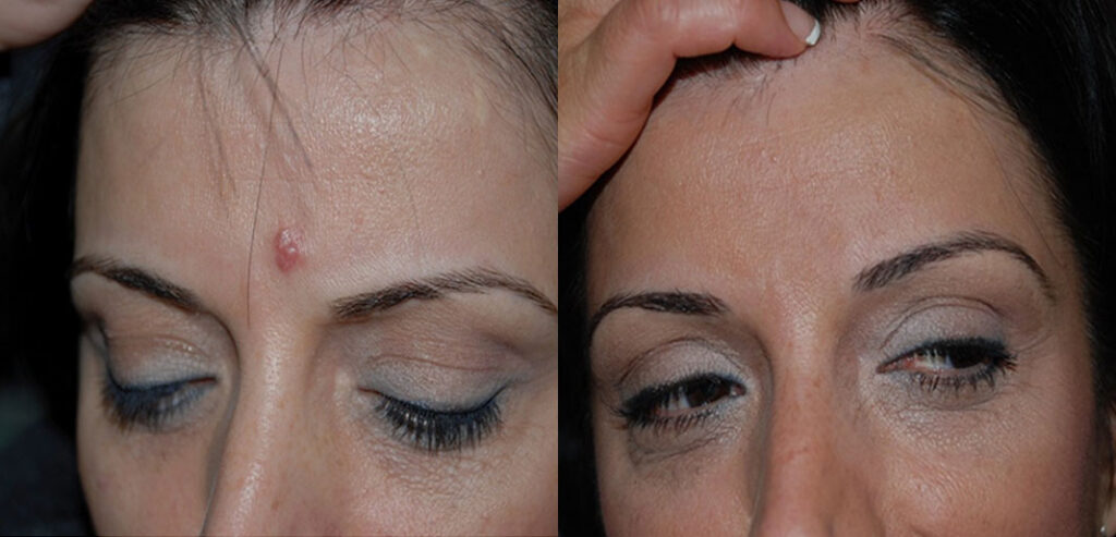 FreezPen — Precision Spot & Lesion Removal
