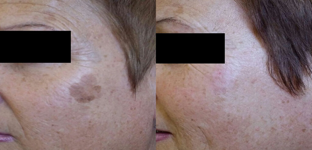 FreezPen — Precision Spot & Lesion Removal