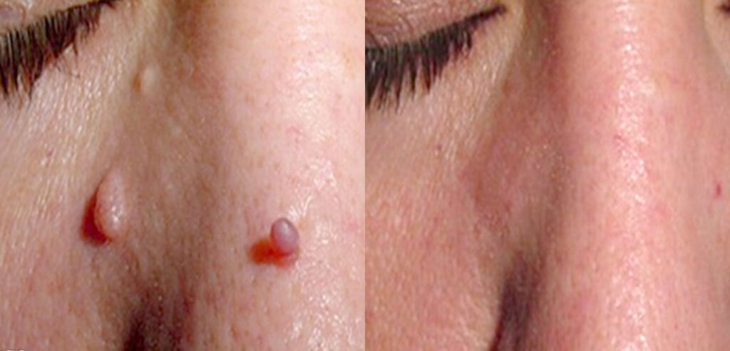 FreezPen — Precision Spot & Lesion Removal