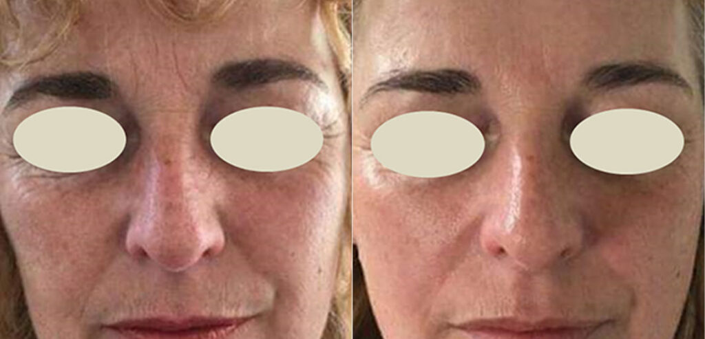 OxyGeneo Super Facial