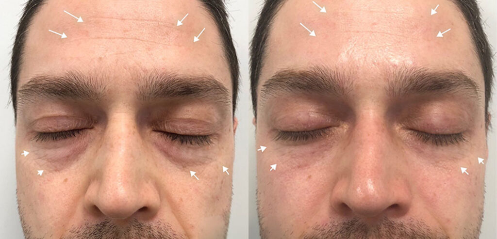 OxyGeneo Super Facial
