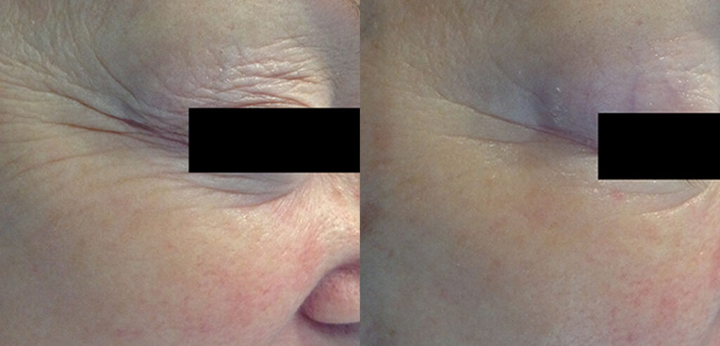 OxyGeneo Super Facial