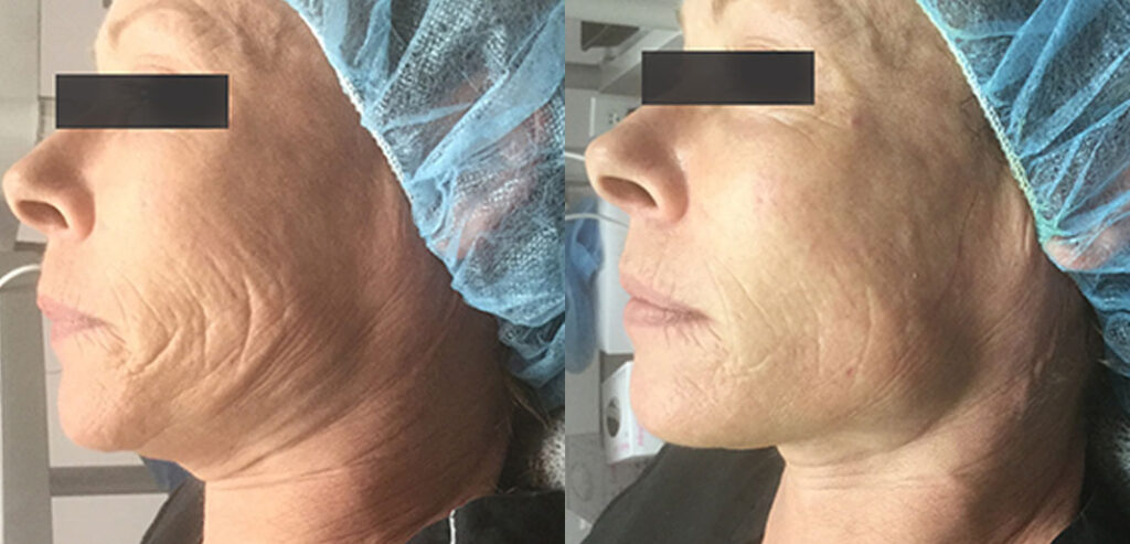 OxyGeneo Super Facial