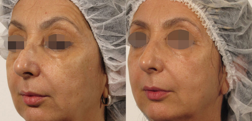 OxyGeneo Super Facial